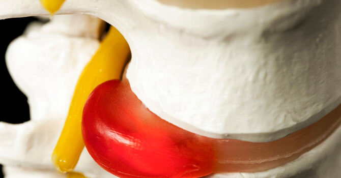 Herniated or Bulging Discs image