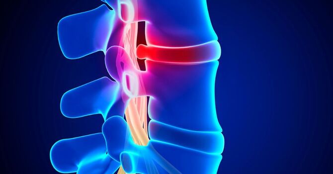 How Do Chiropractors Help with Pinched Nerves? image