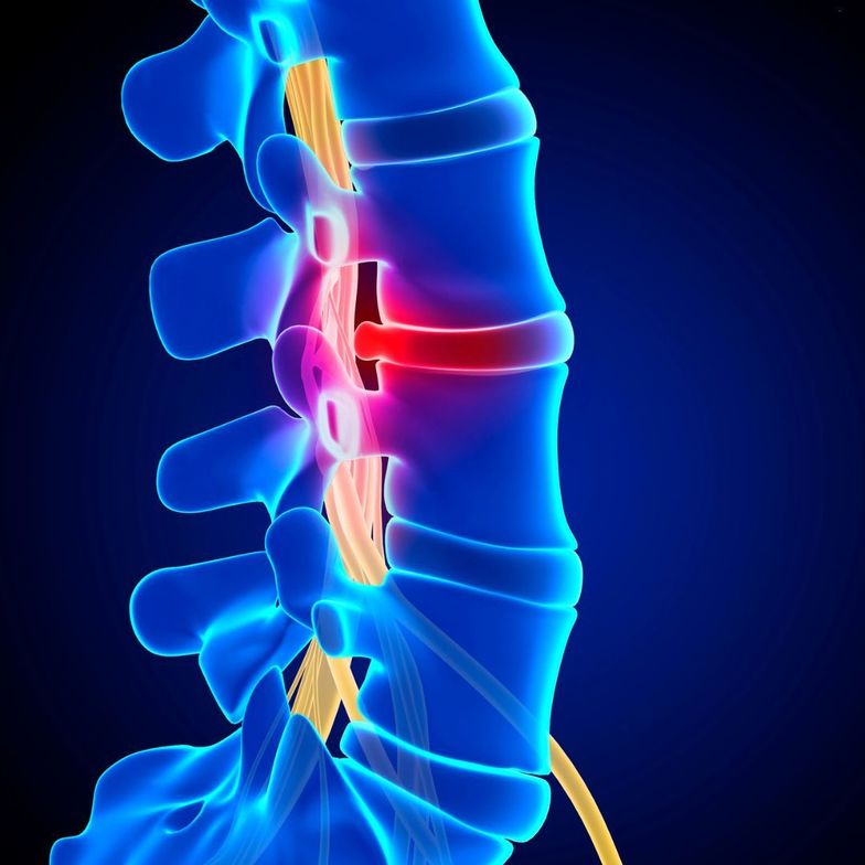 Ankeny chiropractor pinched nerve
